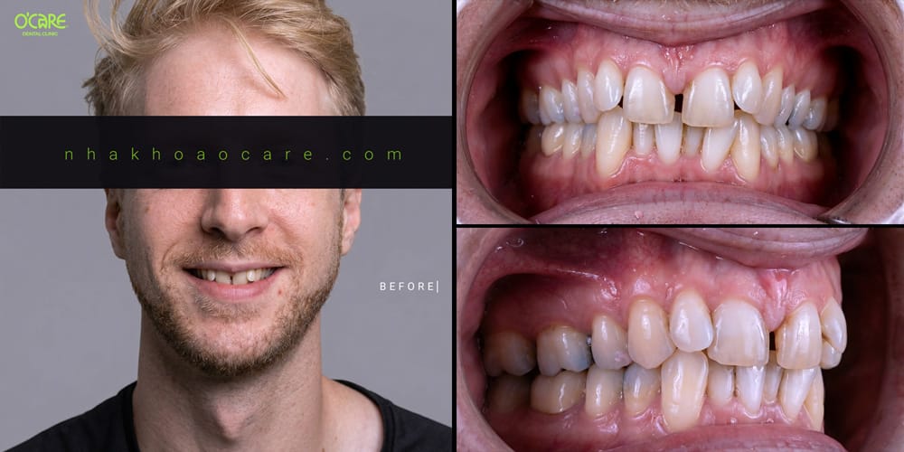 Professional orthodontic treatment in Ho Chi Minh City (1)2