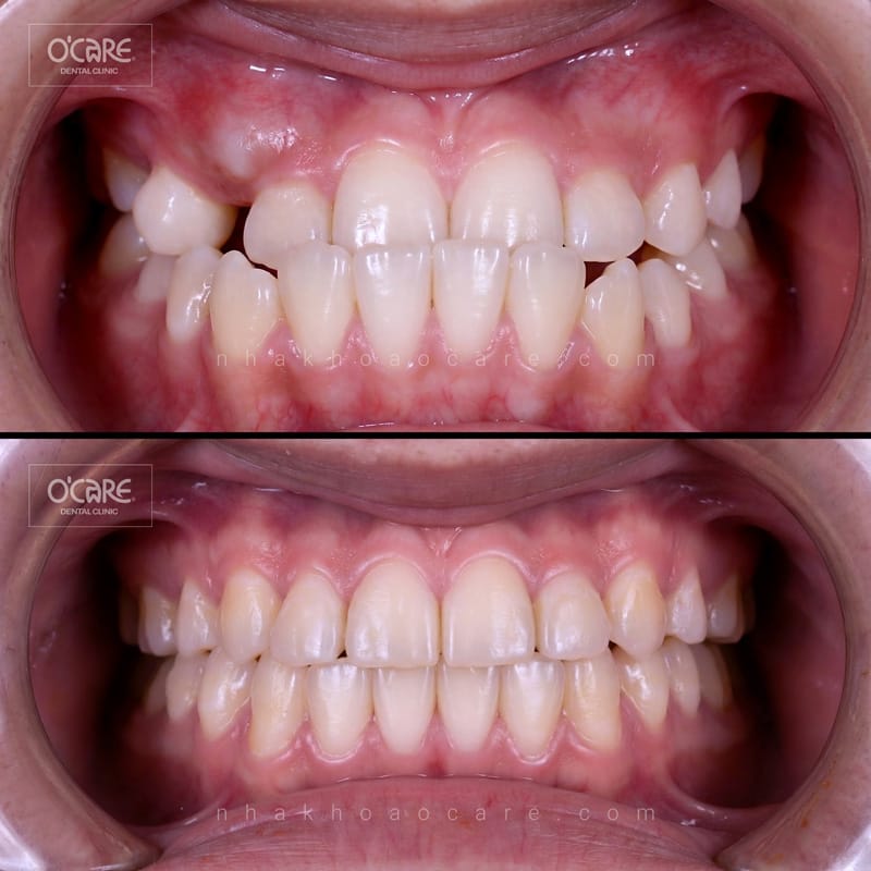 niềng răng điều trị khớp cắn ngược cho trẻ em (3)