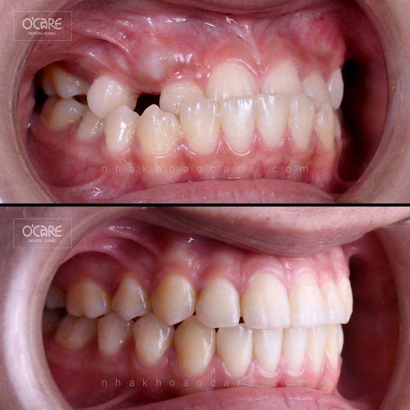 niềng răng điều trị khớp cắn ngược cho trẻ em (3)