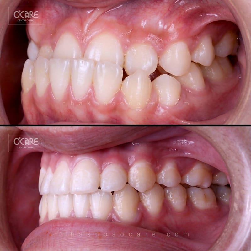 niềng răng điều trị khớp cắn ngược cho trẻ em (3)