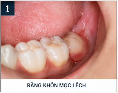 quy trình nhổ răng khôn - răng khôn mọc lệch