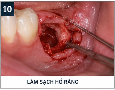 quy trình nhổ răng khôn - làm sạch hố răng