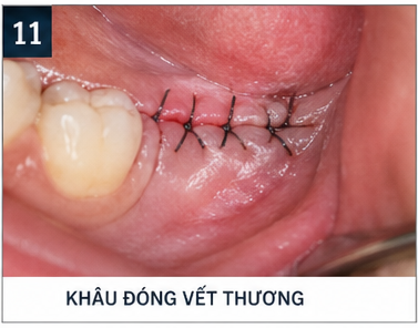 quy trình nhổ răng khôn - khâu vết thương