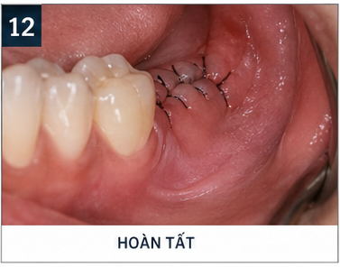 quy trình nhổ răng khôn - hoàn tất
