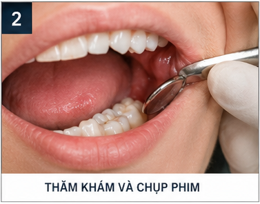 quy trình nhổ răng khôn - khám răng khôn