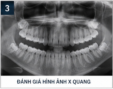 quy trình nhổ răng khôn - chụp xquang răng khôn