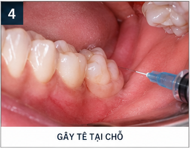 quy trình nhổ răng khôn - gây tê