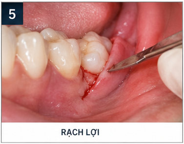 quy trình nhổ răng khôn - rạch lợi