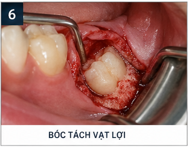 quy trình nhổ răng khôn - bóc tách vạt lợi