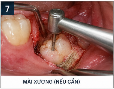 quy trình nhổ răng khôn - mài xương