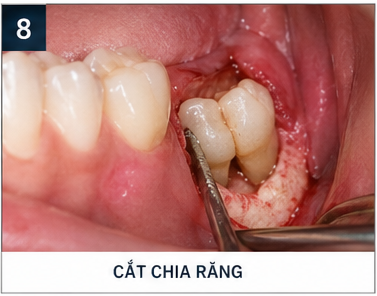 quy trình nhổ răng khôn - cắt răng