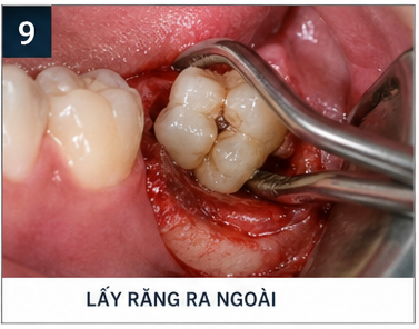 quy trình nhổ răng khôn - lấy răng ra ngoài