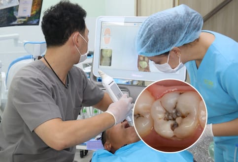 scan răng 3D khám sâu răng