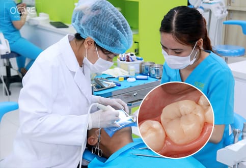 trám răng sâu hoàn tất