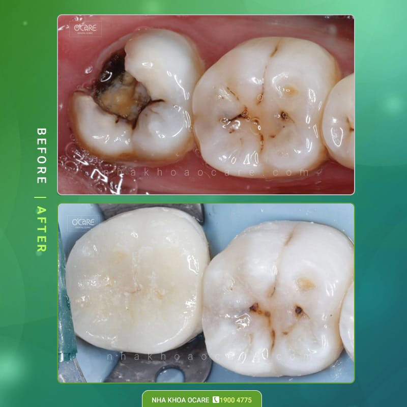 trước và sau trám răng sâu