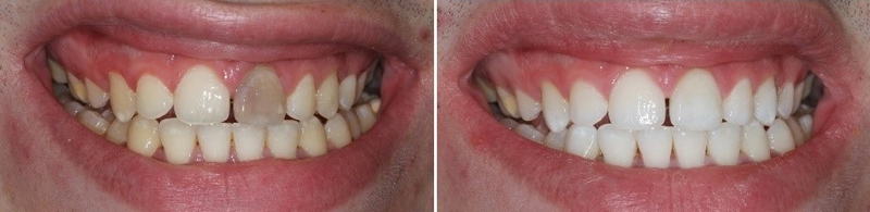 Internal (Dead Tooth) Whitening Ho Chi Minh City