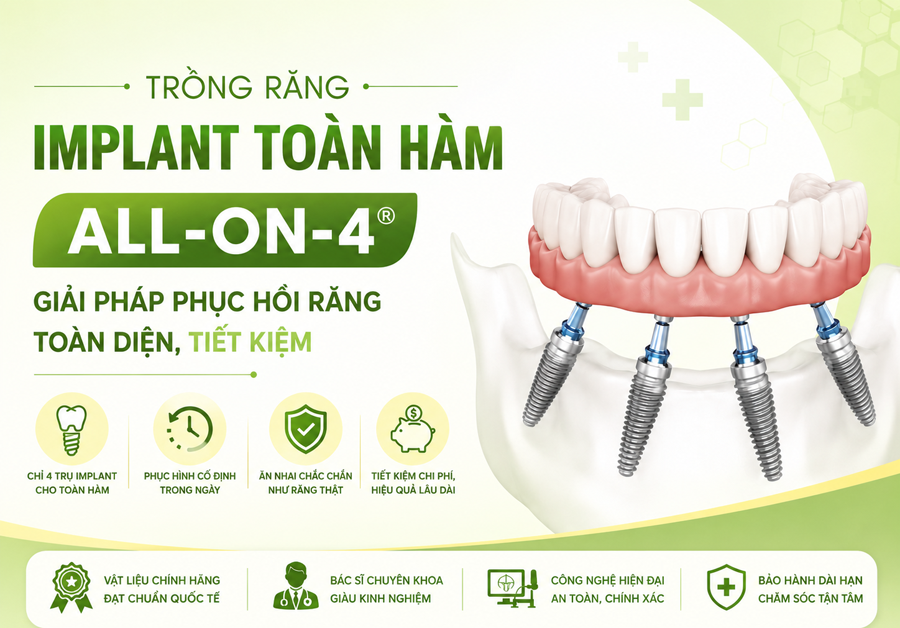  banner cấy ghep implant all on 4