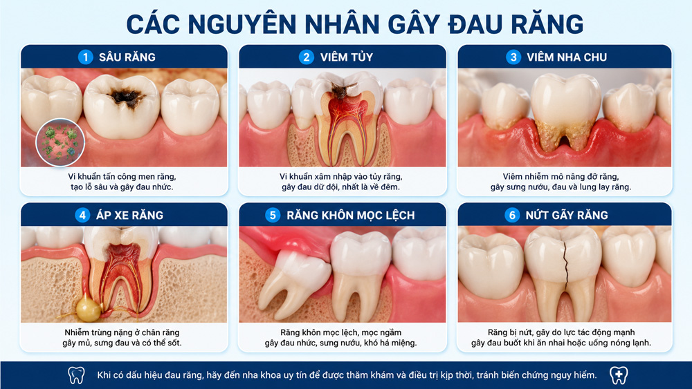 các nguyên nhân gây đau răng - nha khoa quận 3