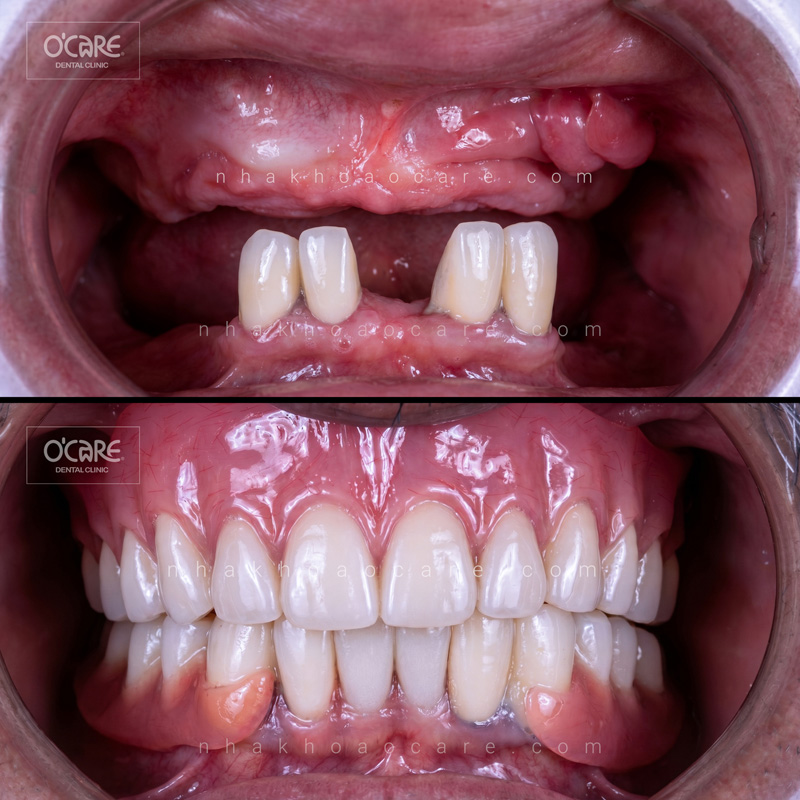 cấy phép implant toàn hàm all on 4 (1)