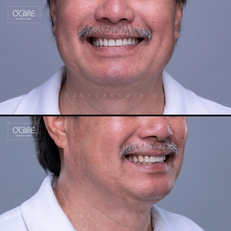 cấy phép implant toàn hàm all on 4 (1)
