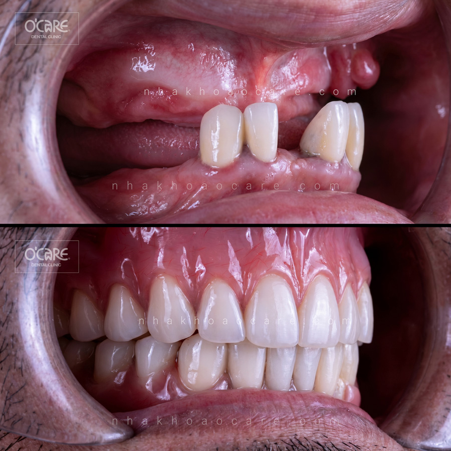 cấy phép implant toàn hàm all on 4 (1)