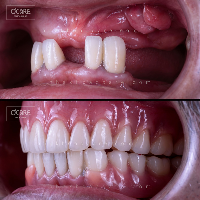 cấy phép implant toàn hàm all on 4 (1)