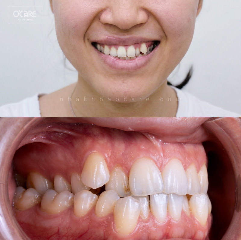 hàm răng khấp khểnh 2
