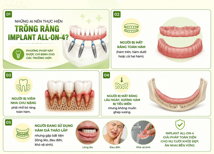 những trường hợp được chỉ định cấy ghép implant all on 4