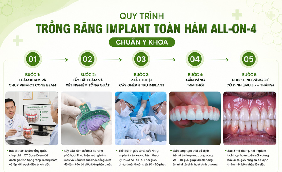 quy trình cấy ghép implant all on 4