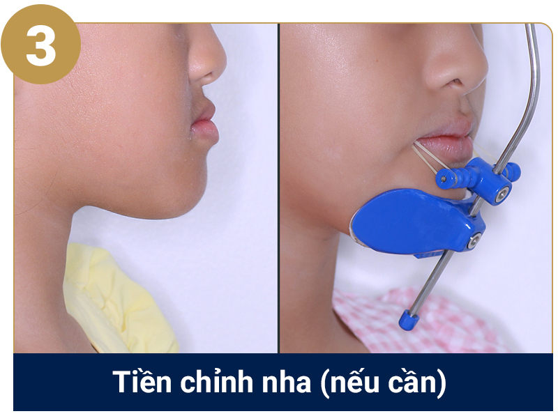 Quy trình niềng răng cắn ngược