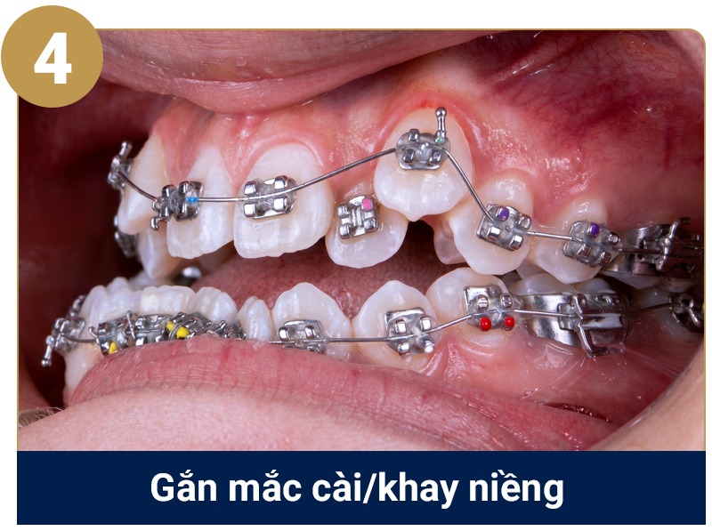 Quy trình niềng răng cắn ngược