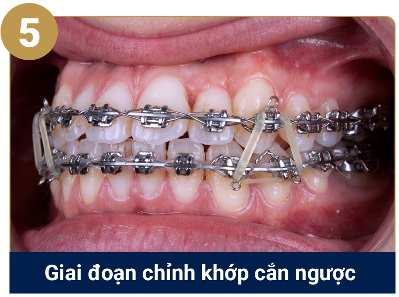 Quy trình niềng răng cắn ngược
