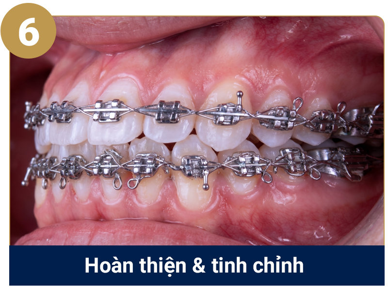 Quy trình niềng răng cắn ngược