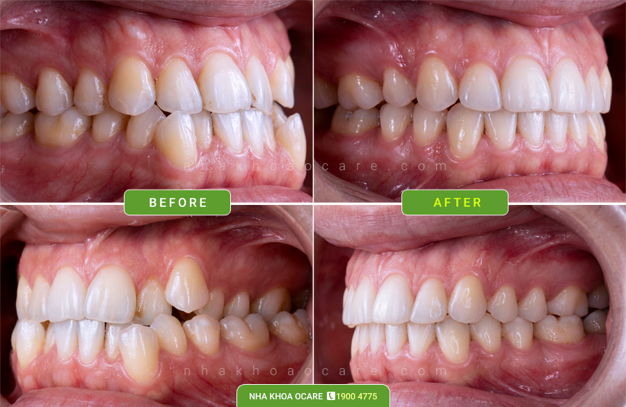 trước và sau niềng răng khấp khểnh tại nha khoa ocare