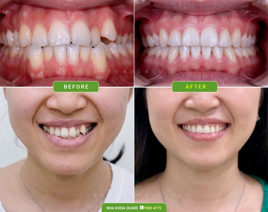 trước và sau niềng răng khấp khểnh tại nha khoa ocare