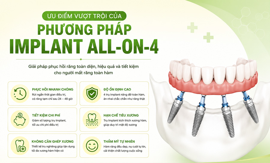 ưu điểm của phương pháp cấy ghép implant all on 4